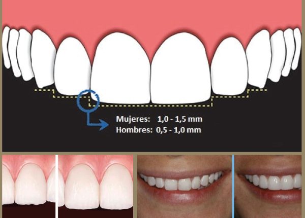 Bordes incisales