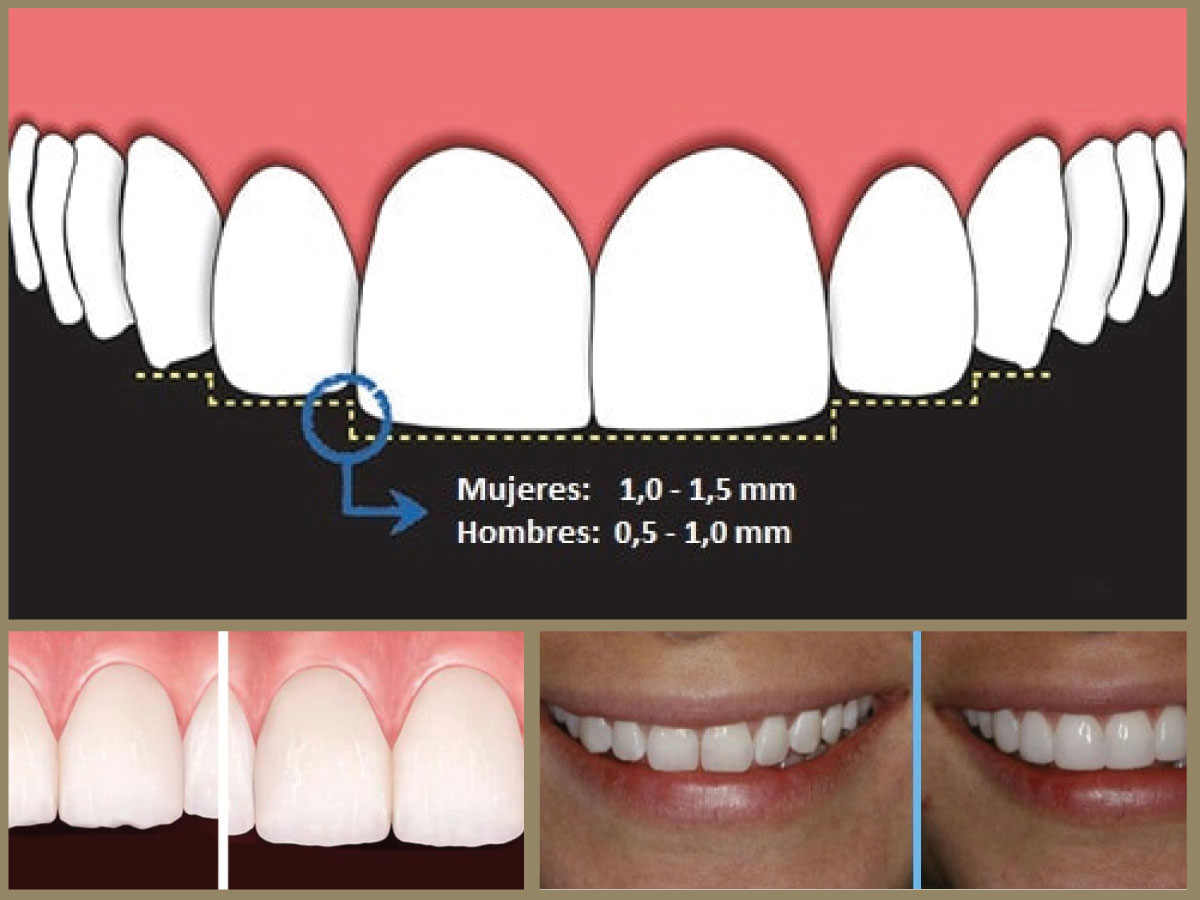 Bordes incisales